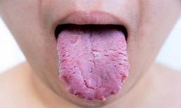 Điều gì sẽ xảy ra nếu bạn không cạo lưỡi thường xuyên