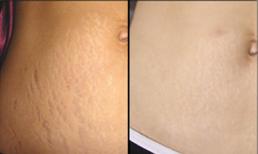 Cách xóa mờ vết rạn da hiệu quả cho 'mẹ bỉm sữa' sau sinh