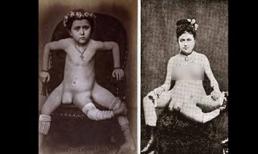 Sốc với cô gái có 3 chân, 4 ngực và 2 âm đạo