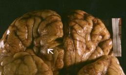 3 loài ký sinh trùng thích làm tổ và ăn não con người cực kỳ nguy hiểm