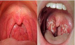 Nguyên nhân, cách phòng chống ung thư vòm họng - 1 trong 5 loại ung thư nguy hiểm nhất