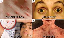 5 dịch bệnh thường bùng phát vào mùa hè, hãy chủ động phòng chống để ngừa tấn công