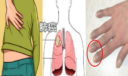 Những dấu hiệu ung thư phổi tuyệt đối không được bỏ qua