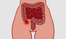 5 dấu hiệu của một người sắp bị vỡ ruột thừa