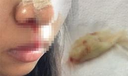 Sửa mũi thất bại, cô gái 3 ngày phải thở bằng miệng vì bác sĩ quên lấy băng gạc