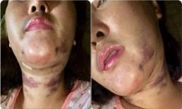 Khuôn mặt kinh dị của cô gái sau khi hút mỡ làm đẹp