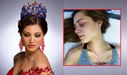 Hoa hậu Trái đất bị nữ ca sĩ Venezuela hành hung đến chấn thương cột sống