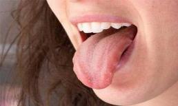 Cứ nghĩ nước bọt buổi sáng là bẩn nhất ai ngờ nó lại trị mụn trứng cá hoàn hảo thế này đây