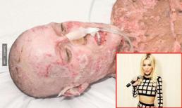 Sự trở lại đáng kinh ngạc của cô gái xinh đẹp bị tạt axit khiến mọi người khâm phục