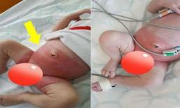 Bé 3 tuần tuổi dùng tã bị sưng tấy, mẩn đỏ hết 'vùng kín' cơ thể