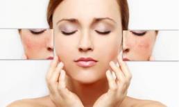 Chia sẻ công nghệ trị nám da mới nhất 2017 bạn cần biết