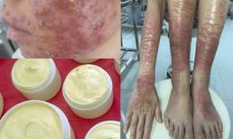 Dấu hiệu nhận biết kem trộn để không gây hậu quả kinh hoàng khi sử dụng