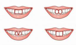 Nhìn răng cửa đoán chính xác tính cách của bạn