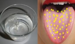 85% phụ nữ ở Mỹ nhiễm nấm Candida – còn bạn? hãy thử ngay cách đơn giản sau để kiểm tra