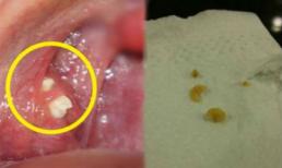 Loại bỏ những 'cục vàng' hôi hám trong miệng siêu dễ dàng