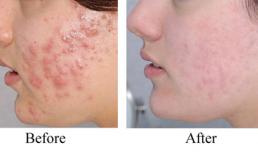 Bí quyết làm đẹp da mỗi ngày - Đánh bay các loại mụn tại nhà