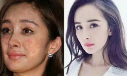 Sự thật đằng sau gương mặt nổi mụn đỏ, thâm nám của Dương Mịch