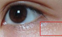 Cách loại bỏ các hạt chất béo mọc quanh mắt gây khó chịu và xấu xí 