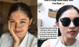 Thùy Dung bị thủy đậu vì lây bệnh của bạn cùng phòng khi tham gia Hoa hậu Quốc tế