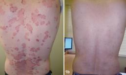 Kiểm soát bệnh vẩy nến hiệu quả bằng thảo dược Dr Michaels