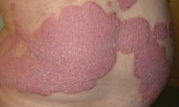 Tinh dầu thực vật giúp phục hồi tế bào bệnh vẩy nến