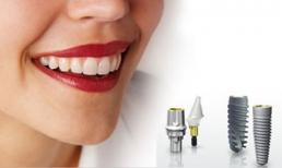 Cách tiết kiệm chi phí trồng răng Implant nguyên hàm