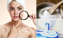 Thoát khỏi mụn trứng cá với 5 công thức tuyệt vời từ kem đánh răng