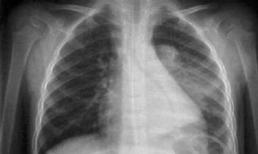 Nguyên nhân và cách điều trị tràn dịch màng phổi