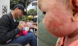 Đình Bảo suýt đui mắt, con lở nát mặt vì lý do này!