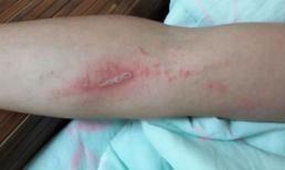 Cẩn thận với những cơn mưa mùa hè vì nó mang đến sinh vật có thể gây loét da khủng khiếp