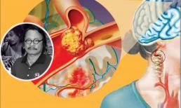 Dấu hiệu nhận biết bệnh tai biến mạch máu não và cách phòng tránh căn bệnh đã khiến 'Chí Phèo' Bùi Cường đột ngột qua đời 