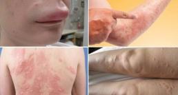 3 bài thuốc trị tận gốc dị ứng, mề đay đang được săn lùng nhất trong thời gian qua