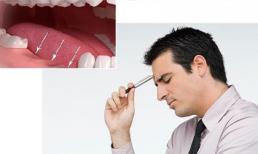 Trồng răng hàm vĩnh viễn bằng loại nào tốt nhất? 