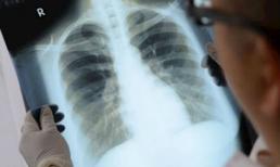 6 dấu hiệu của bệnh ung thư phổi bạn cần biết ngay, đau ngón tay tưởng đơn giản mà cũng là một trong số đó