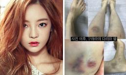 Hình ảnh bầm tím khắp cơ thể của “búp bê xứ Hàn” Goo Hara được tung ra sau khi bạn trai tố cô hành hung