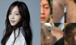 Bị kiến nghị cho ngồi tù, bạn trai cũ công bố toàn bộ vết thương do Goo Hara gây ra cùng 6 lời biện minh