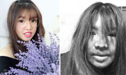 'Thị Nở tái sinh' Quách Phượng gây xôn xao với gương mặt sưng bầm dập