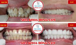 Bọc răng sứ không cần mài răng, có đúng sự thật?