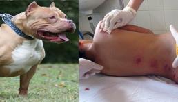 Hà Nội: Chủ nhà và hàng xóm đều nhập viện do bị chó Pitbull tấn công