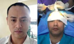 Bị hói, ca sĩ Ưng Đại Vệ quyết định cấy 2000 sợi tóc