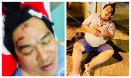Nghệ sĩ Hoàng Mập bị tai nạn giao thông, thương tích khắp người