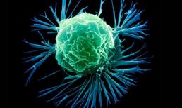 Ung thư cũng biết 'chọn mặt gửi mầm bệnh' với 8 nhóm người: Ai cũng nên xem để phòng tránh