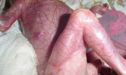 Bé sơ sinh đẻ ra không có da chỉ vì mẹ uống nhầm loại thuốc này khi mang thai