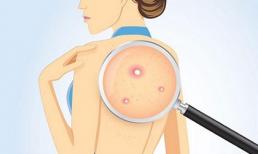 Mụn ở lưng khó ưa sẽ bị diệt tận gốc và biến mất chỉ trong 1 đêm với công thức sau