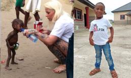 Cậu bé da bọc xương bị xã hội hắt hủi từng gây chấn động thế giới sau 2 năm giờ ra sao?