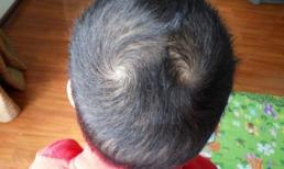 Thực hư câu nói ‘Một xoáy sống lâu, hai xoáy trọc đầu, ba xoáy chết yểu, 4 xoáy làm quan’?