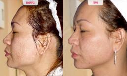 Điều trị sẹo rỗ miễn phí tại thẩm mỹ Hồng Kông 51 Hàng Gà