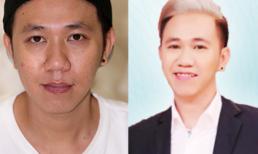 Chàng trai năm ấy 'diễn viên Anh Đức' đã lấy lại phong độ nhờ trị sạch sẹo rỗ