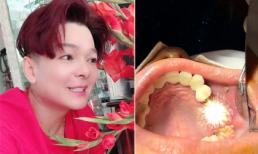 Muốn biết trùng tu lại răng sứ đau đớn và mất thời gian như thế nào hãy đọc chia sẻ của ca sĩ Vũ Hà