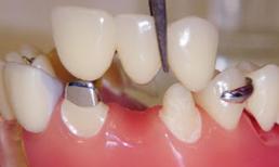 Những điều chưa biết về làm Cầu Răng Sứ